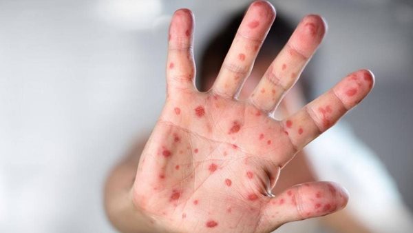 Monkeypox likely to cause more deaths: WHO